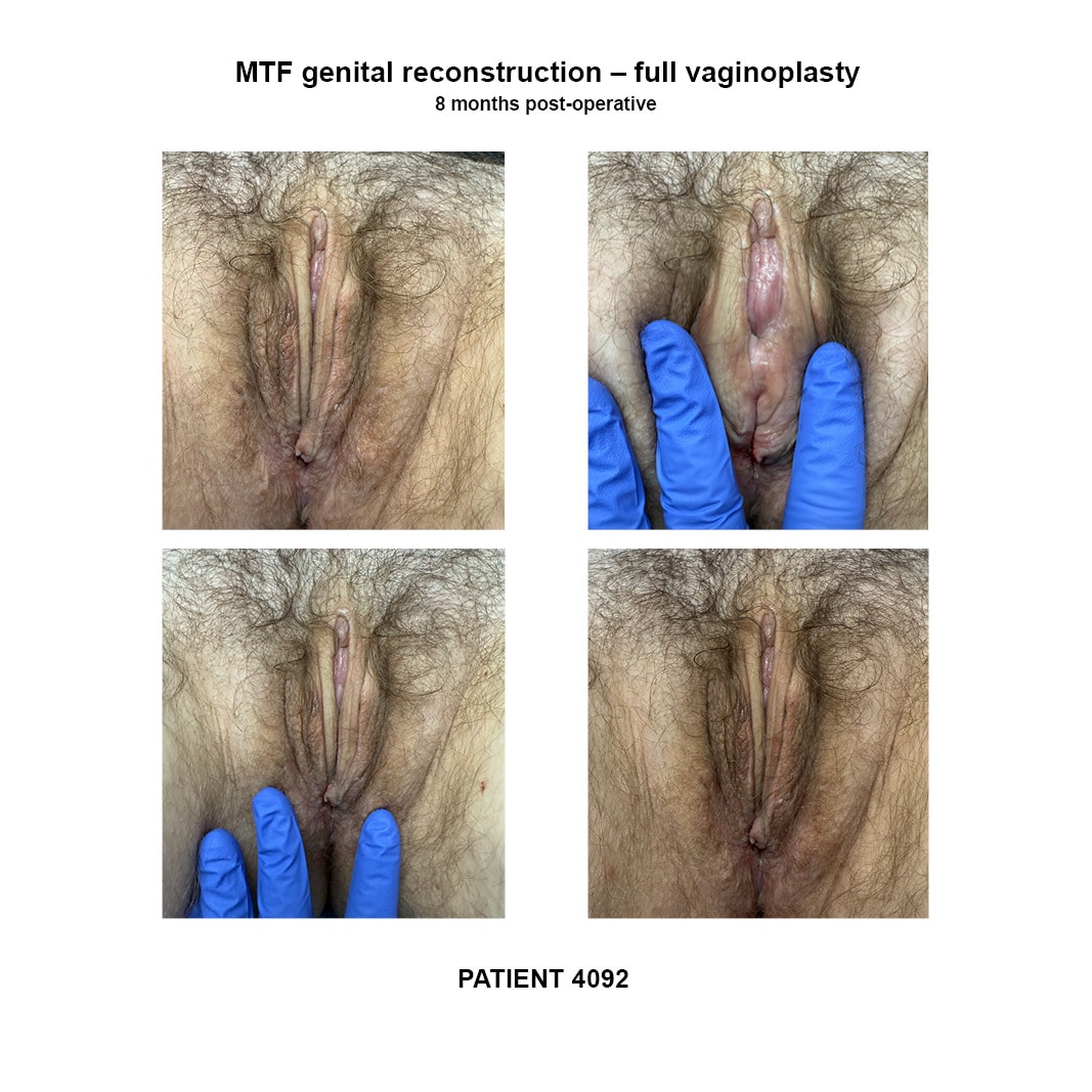 4092_GRS full vaginoplasty