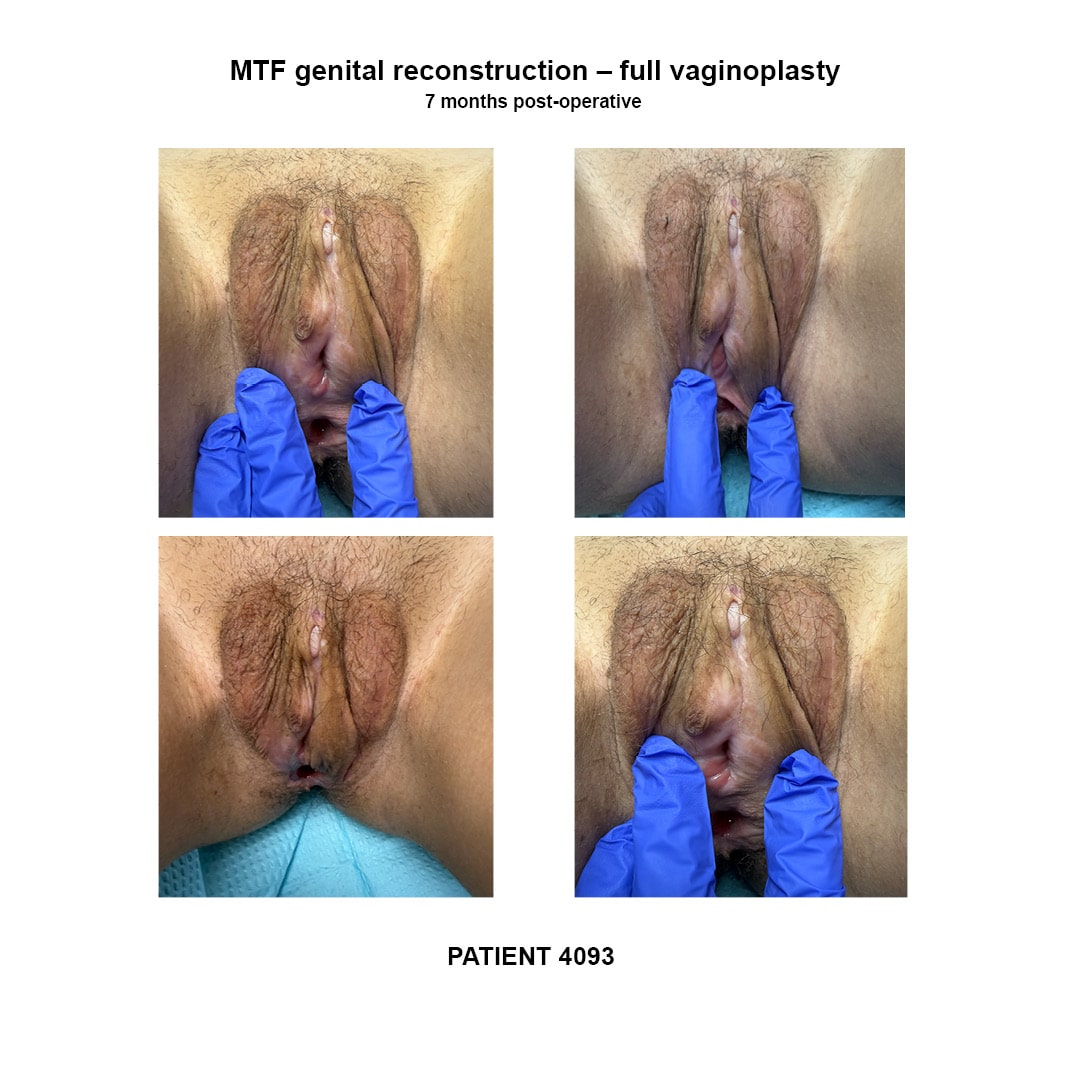 4093_GRS full vaginoplasty