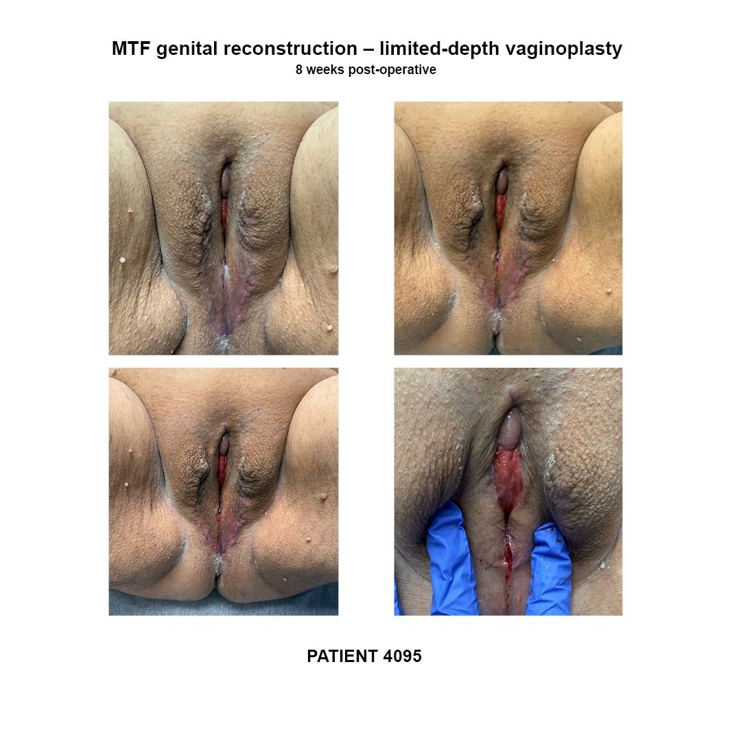 4095_GRS limited-depth vaginoplasty