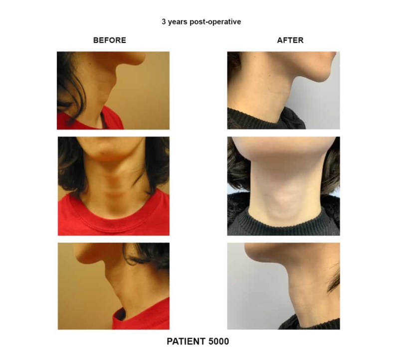 5000_FaceFem_tracheal shave