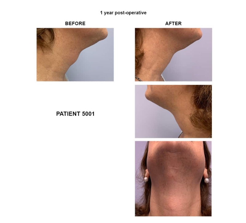 5001_FaceFem_tracheal shave