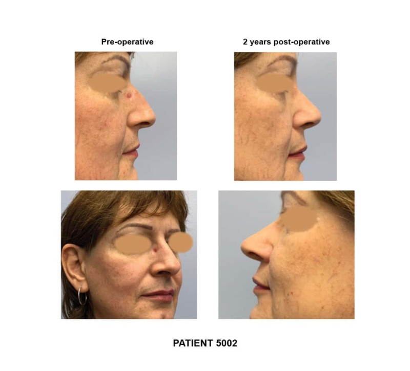 5002_FaceFem_rhinoplasty