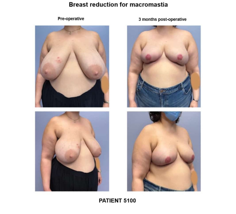 5100_Breast reduction macromastia