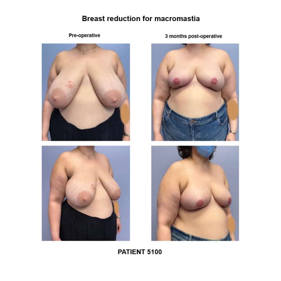 5100_Breast reduction macromastia