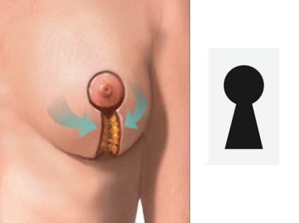 breast reduction surgery keyhole surgery method 