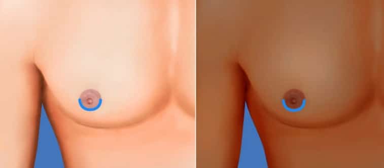 Breast reduction surgery peri areolar surgery method