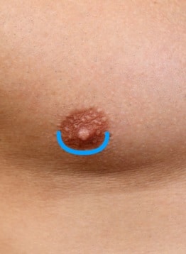 peri-areolar incision for breast reduction surgery